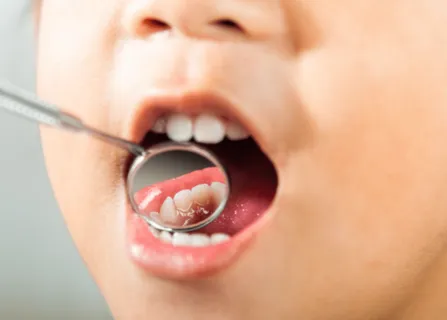 Image related to when pulp therapy is needed