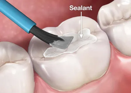 Image related to when are sealants recommended?
