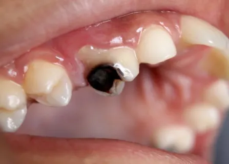 Image related to tooth-colored restorations (white fillings)