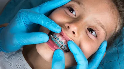 Image about orthodontics (interceptive ortho)