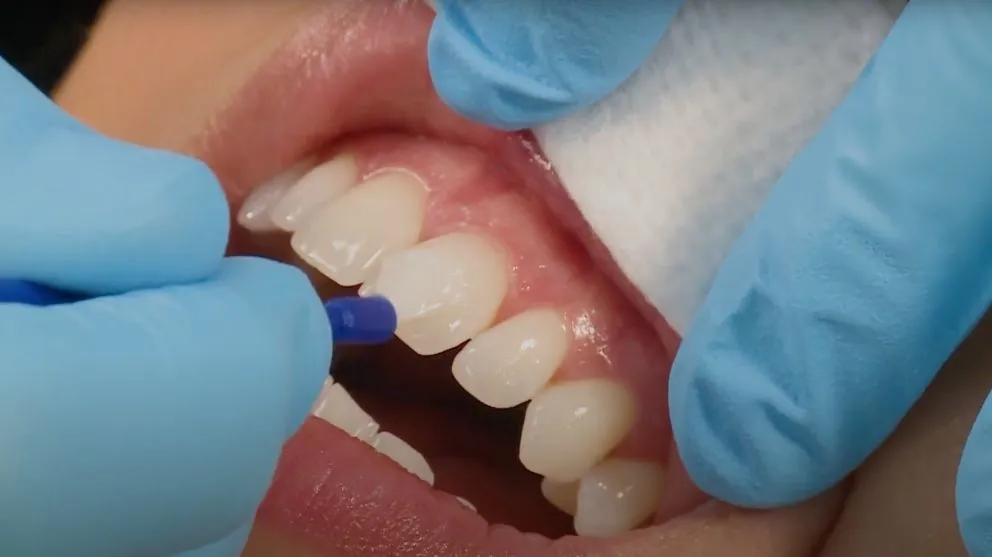 A Small Step That Protects Big Smiles