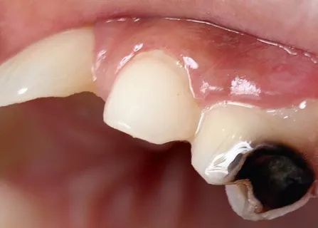 Image related to crowns (when more coverage is needed)