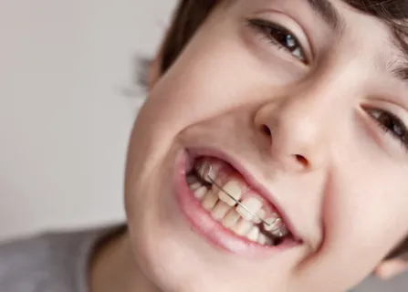 Image related to protruding front teeth