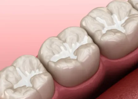 Image related to how long do sealants last?