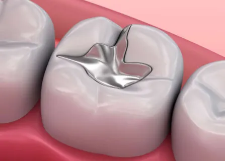 Image related to natural-looking filling options