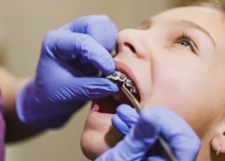 Image related to teeth erupting in the wrong position