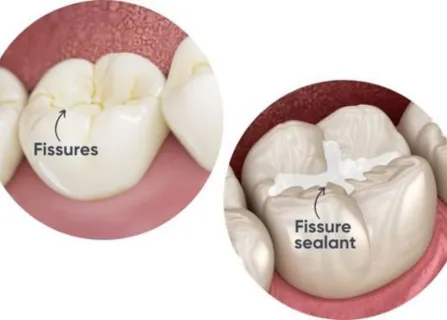 Image related to why parents choose sealants