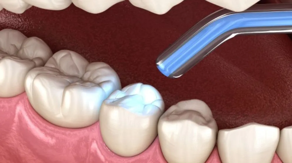 Comfort-Led Fillings for Small Smiles