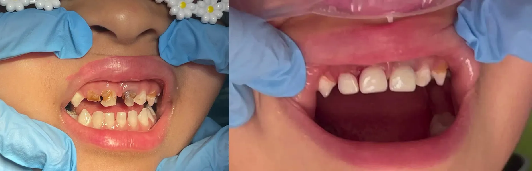 Image related to before & after: decay to a full smile