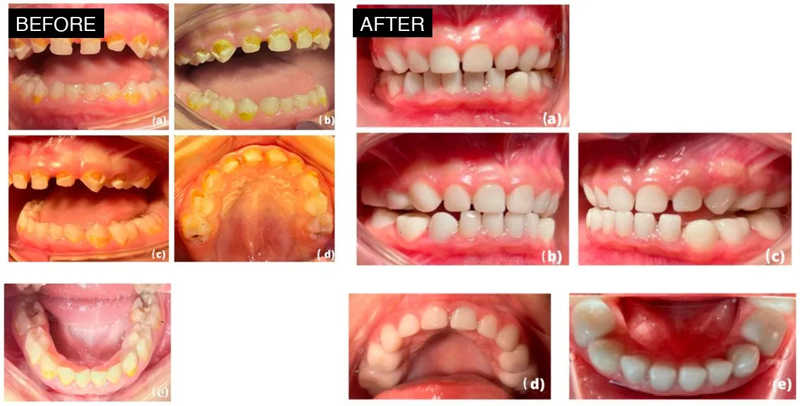 Image related to zirconia crowns for baby teeth